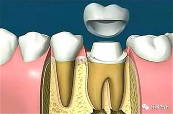 補(bǔ)牙不做冠，療效少一半！根管治療后牙齒已經(jīng)不疼了，為什么還要戴牙冠呢？