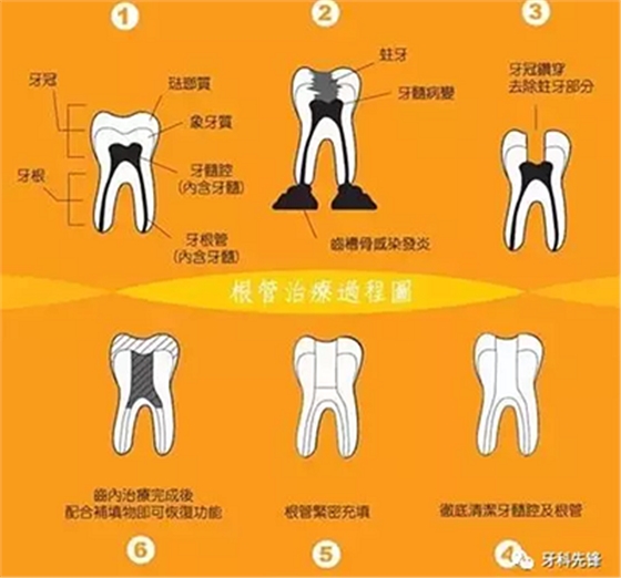 補(bǔ)牙不做冠，療效少一半！根管治療后牙齒已經(jīng)不疼了，為什么還要戴牙冠呢？