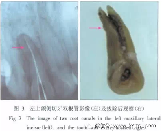 X線牙片在牙齒疑難病例診斷中的參考價值