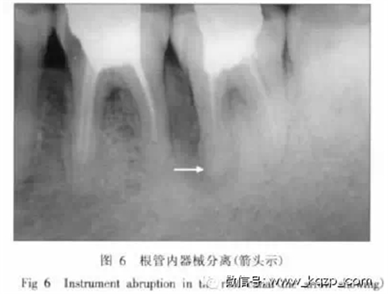 X線牙片在牙齒疑難病例診斷中的參考價值