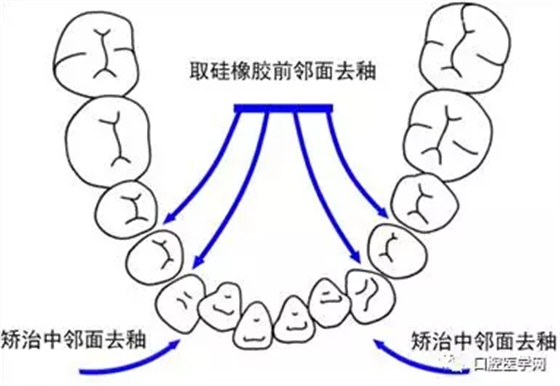 鄰面去釉技術(shù)詳解