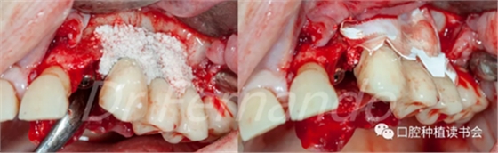 種植體周圍炎的軟硬組織重建治療(下)