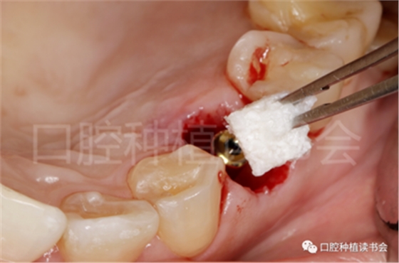 后牙區(qū)即刻種植臨床指南