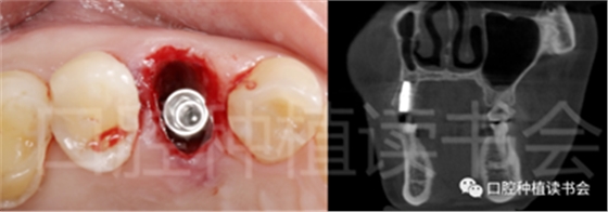 后牙區(qū)即刻種植臨床指南