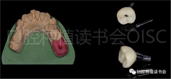 后牙區(qū)即刻種植臨床指南