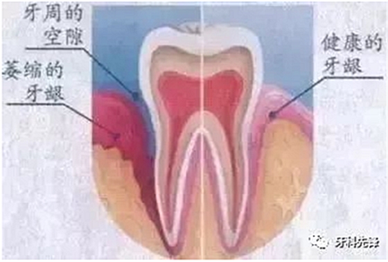 	牙齦萎縮是不治之癥？緩解牙齦萎縮5步走！