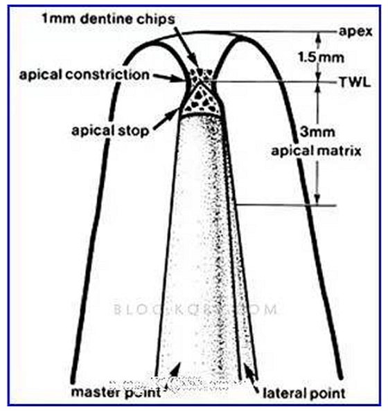 巧用牙膠尖，防止充填時發(fā)生超充或欠充