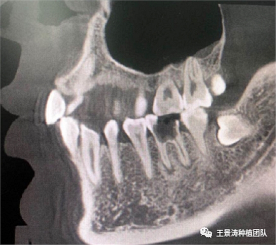 后牙區(qū)即刻種植的適應癥的思考