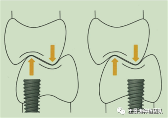 后牙區(qū)即刻種植的適應癥的思考