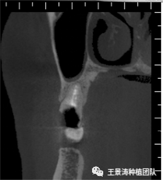 后牙區(qū)即刻種植的適應癥的思考