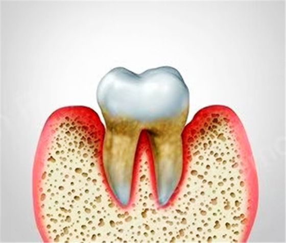 牙周病總是來(lái)勢(shì)洶洶？有辦法預(yù)防嗎？
