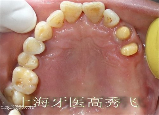 圖解后牙精密附著體修復(fù)2例（原創(chuàng)）