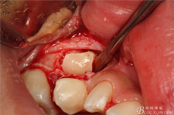 微創(chuàng)法摘除下頜第二前磨牙含牙囊腫