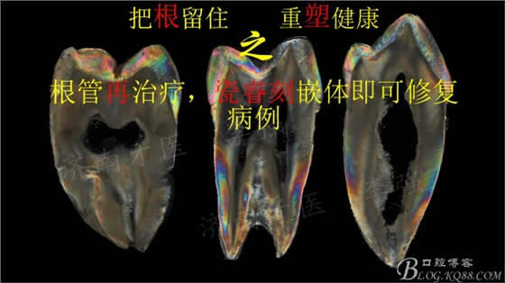 根管再治療，高嵌體即可修復(fù)（濟南牙醫(yī)~ 李強）