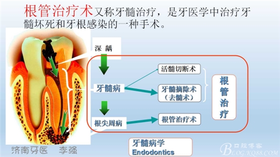 根管再治療，高嵌體即可修復(fù)（濟南牙醫(yī)~ 李強）