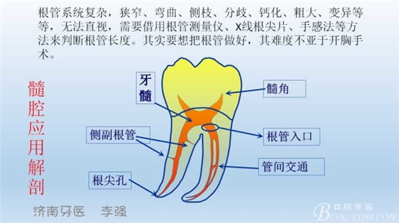 根管再治療，高嵌體即可修復(fù)（濟南牙醫(yī)~ 李強）