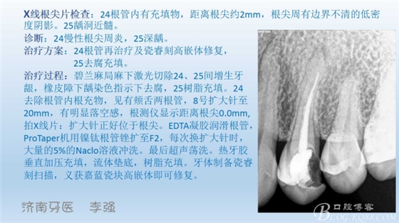 根管再治療，高嵌體即可修復(fù)（濟南牙醫(yī)~ 李強）