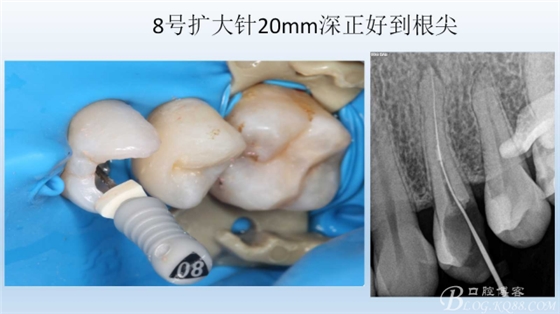 根管再治療，高嵌體即可修復(fù)（濟南牙醫(yī)~ 李強）