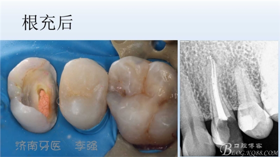 根管再治療，高嵌體即可修復(fù)（濟南牙醫(yī)~ 李強）