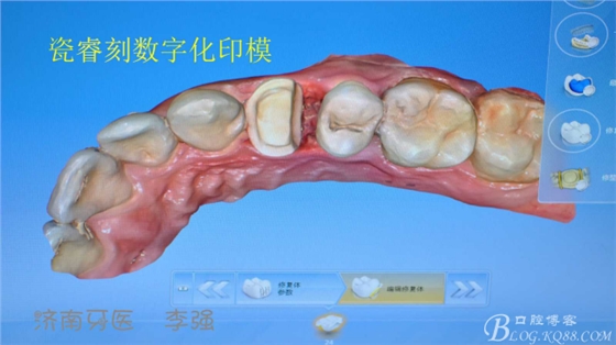 根管再治療，高嵌體即可修復(fù)（濟南牙醫(yī)~ 李強）