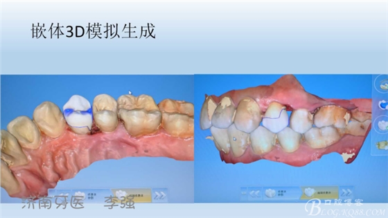 根管再治療，高嵌體即可修復(fù)（濟南牙醫(yī)~ 李強）