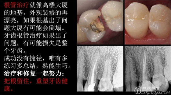 根管再治療，高嵌體即可修復(fù)（濟南牙醫(yī)~ 李強）