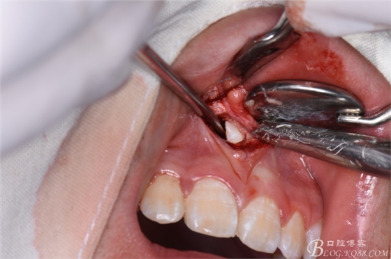 雙切口拔除鼻底埋伏多生牙