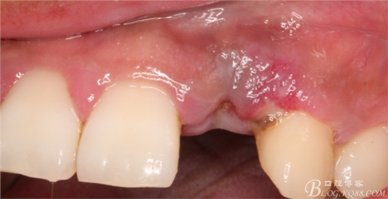 一例上前牙種植失敗病例的補(bǔ)救(梁光強(qiáng)) 一例上前牙種植失敗病例的補(bǔ)救(梁光強(qiáng))