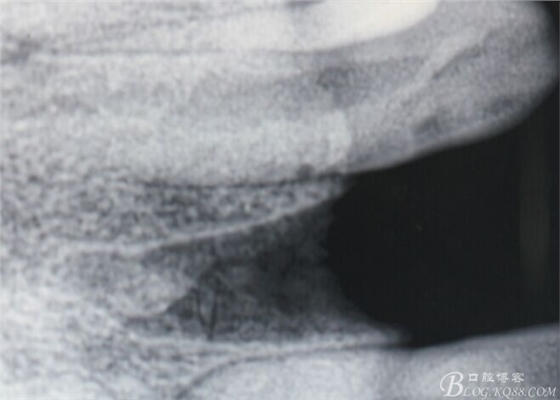 一例上前牙種植失敗病例的補(bǔ)救(梁光強(qiáng)) 一例上前牙種植失敗病例的補(bǔ)救(梁光強(qiáng))