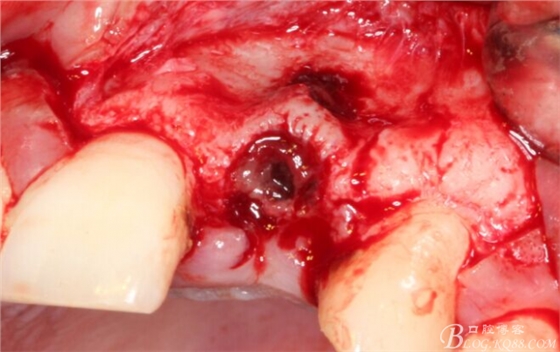 一例上前牙種植失敗病例的補(bǔ)救(梁光強(qiáng)) 一例上前牙種植失敗病例的補(bǔ)救(梁光強(qiáng))