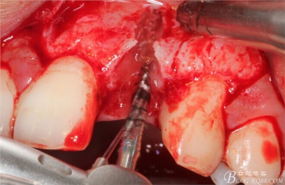 一例上前牙種植失敗病例的補(bǔ)救(梁光強(qiáng)) 一例上前牙種植失敗病例的補(bǔ)救(梁光強(qiáng))