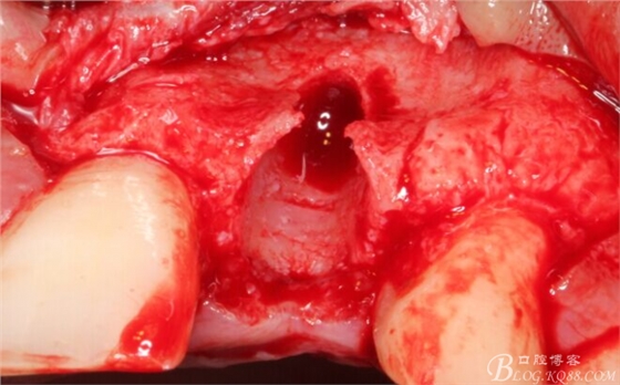 一例上前牙種植失敗病例的補(bǔ)救(梁光強(qiáng)) 一例上前牙種植失敗病例的補(bǔ)救(梁光強(qiáng))