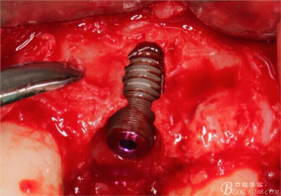 一例上前牙種植失敗病例的補(bǔ)救(梁光強(qiáng)) 一例上前牙種植失敗病例的補(bǔ)救(梁光強(qiáng))