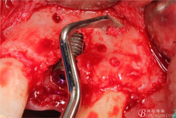 一例上前牙種植失敗病例的補(bǔ)救(梁光強(qiáng)) 一例上前牙種植失敗病例的補(bǔ)救(梁光強(qiáng))