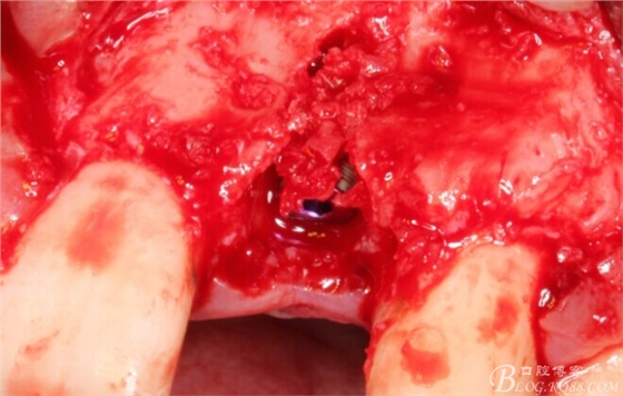 一例上前牙種植失敗病例的補(bǔ)救(梁光強(qiáng)) 一例上前牙種植失敗病例的補(bǔ)救(梁光強(qiáng))