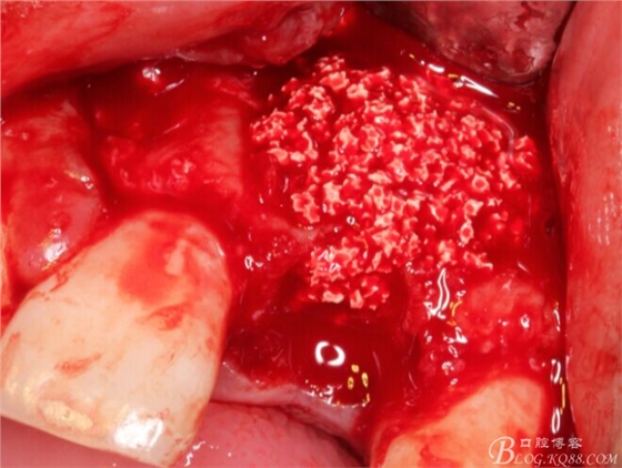 一例上前牙種植失敗病例的補(bǔ)救(梁光強(qiáng)) 一例上前牙種植失敗病例的補(bǔ)救(梁光強(qiáng))