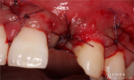 一例上前牙種植失敗病例的補(bǔ)救(梁光強(qiáng)) 一例上前牙種植失敗病例的補(bǔ)救(梁光強(qiáng))