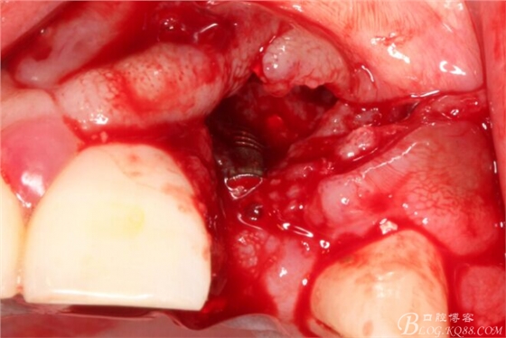 一例上前牙種植失敗病例的補(bǔ)救(梁光強(qiáng)) 一例上前牙種植失敗病例的補(bǔ)救(梁光強(qiáng))