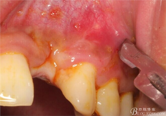 一例上前牙種植失敗病例的補(bǔ)救(梁光強(qiáng)) 一例上前牙種植失敗病例的補(bǔ)救(梁光強(qiáng))