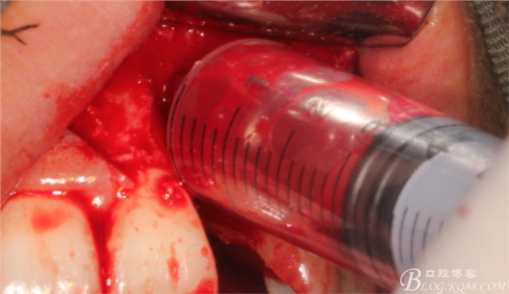 一例上前牙種植失敗病例的補(bǔ)救(梁光強(qiáng)) 一例上前牙種植失敗病例的補(bǔ)救(梁光強(qiáng))