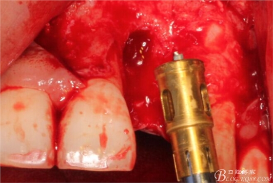 一例上前牙種植失敗病例的補(bǔ)救(梁光強(qiáng)) 一例上前牙種植失敗病例的補(bǔ)救(梁光強(qiáng))