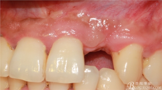 一例上前牙種植失敗病例的補(bǔ)救(梁光強(qiáng)) 一例上前牙種植失敗病例的補(bǔ)救(梁光強(qiáng))