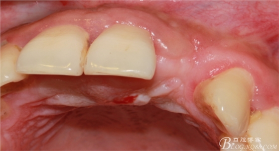 一例上前牙種植失敗病例的補(bǔ)救(梁光強(qiáng)) 一例上前牙種植失敗病例的補(bǔ)救(梁光強(qiáng))