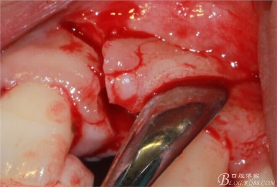 一例上前牙種植失敗病例的補(bǔ)救(梁光強(qiáng)) 一例上前牙種植失敗病例的補(bǔ)救(梁光強(qiáng))