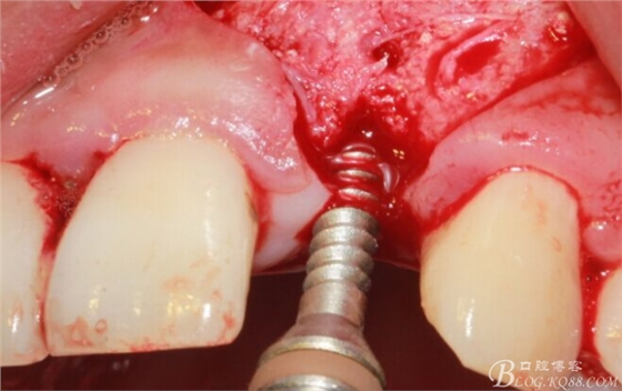 一例上前牙種植失敗病例的補(bǔ)救(梁光強(qiáng)) 一例上前牙種植失敗病例的補(bǔ)救(梁光強(qiáng))