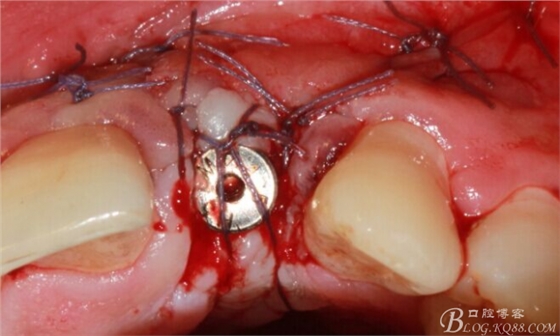 一例上前牙種植失敗病例的補(bǔ)救(梁光強(qiáng)) 一例上前牙種植失敗病例的補(bǔ)救(梁光強(qiáng))