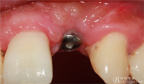 一例上前牙種植失敗病例的補(bǔ)救(梁光強(qiáng)) 一例上前牙種植失敗病例的補(bǔ)救(梁光強(qiáng))