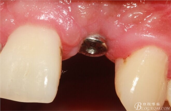 一例上前牙種植失敗病例的補(bǔ)救(梁光強(qiáng)) 一例上前牙種植失敗病例的補(bǔ)救(梁光強(qiáng))