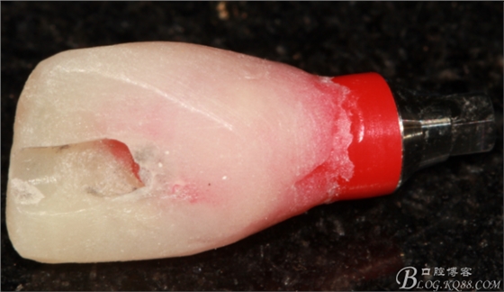 一例上前牙種植失敗病例的補(bǔ)救(梁光強(qiáng)) 一例上前牙種植失敗病例的補(bǔ)救(梁光強(qiáng))