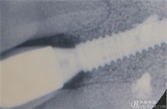 一例上前牙種植失敗病例的補(bǔ)救(梁光強(qiáng)) 一例上前牙種植失敗病例的補(bǔ)救(梁光強(qiáng))